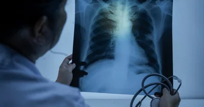 На факультете фундаментальной медицины МГУ выявлен туберкулез