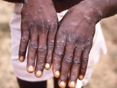 monkeypoWhat is Mpox and why WHO has declared the outbreak a Global Health Emergency 