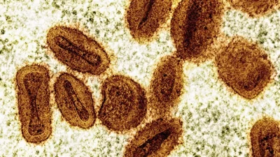 U.S. health officials report first case of new form of mpox in a traveler