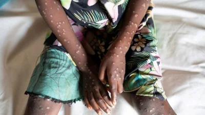 Africa put on high alert for Mpox; outbreak declared public health emergency  - NewZimbabwe.com