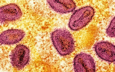 First case of dangerous new mpox strain confirmed in the UK