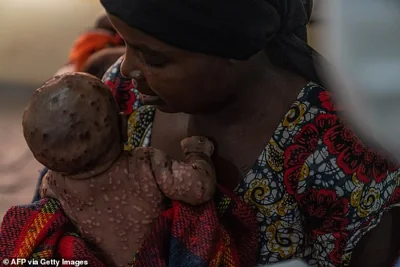 A woman cares her baby suffering from a severe form of mpox in eastern Democratic Republic of Congo