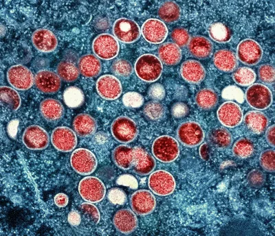 Sweden’s public health agency has recorded what it says is its first case of a contagious new variant of mpox