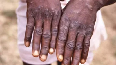 Sweden Confirms First Case Of Mpox Outside Africa Amid Global Public Health Emergency WHO Sweden Confirms First Case Of Mpox Outside Africa Amid Global Public Health Emergency