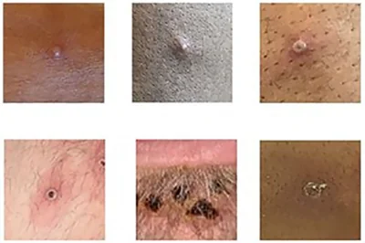 The skin rash or pus-filled lesions can last two to four weeks